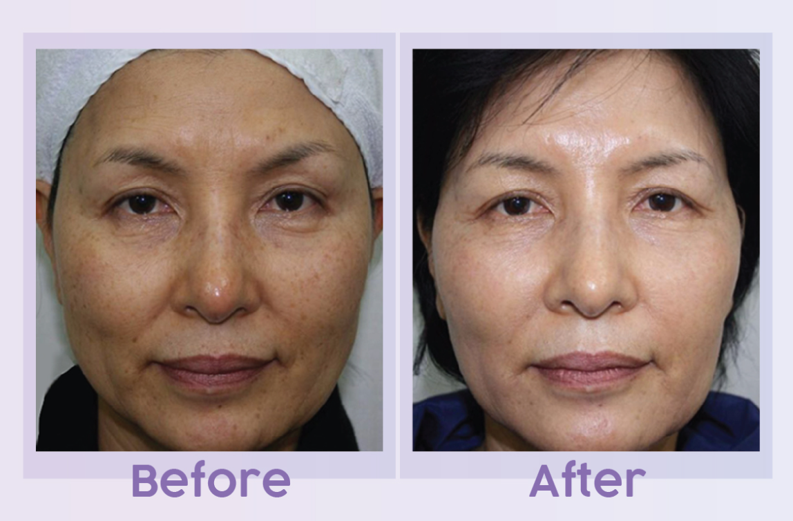 PRP before and after result 1